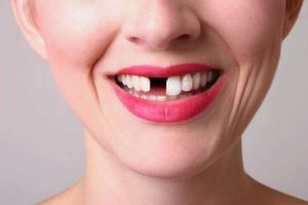 Особенности перелома зуба